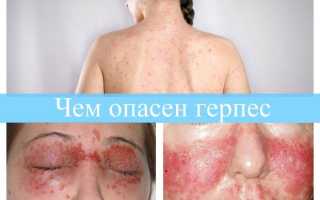 Чем опасен герпес