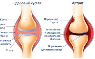 Лечение народными средствами артрита: эффективные способы