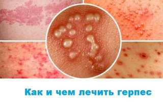 Герпес лечение