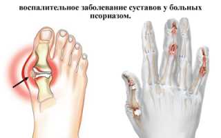 Как при артрите выполнять упражнения для суставов