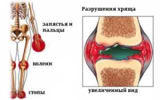 Диагностика ювенального ревматоидного артрита и его лечение