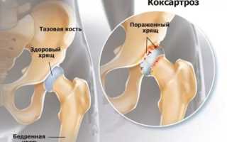 Коксартроз приводит к операции в 90% случаев