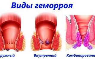 Чем снять зуд при геморрое и жжение