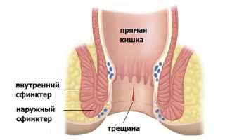 Анальное жжение