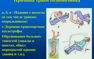 Перелом позвоночника: все факты о травме
