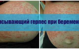 Опоясывающий герпес при беременности