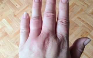Опухли пальцы и на руках зуд