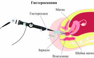 Может ли быть жжение после гистероскопии