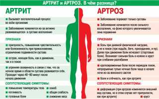 Артрит и артроз — в чем разница?
