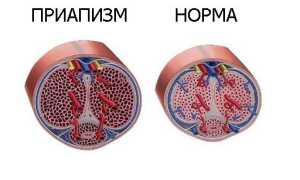 Чем вредна длительная эрекция