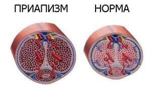 Чем вредна длительная эрекция