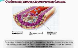Атероматозные бляшки