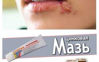 Цинковая мазь от герпеса