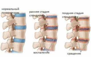 Заболевание позвоночника гнойный спондилит