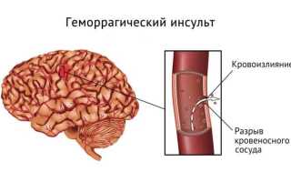 Инсульт и инфаркт одновременно шансы выжить
