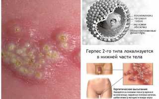 Генитальный герпес