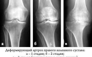 Гонартроз коленного сустава 1 и 2 степени: его симптомы и лечение 