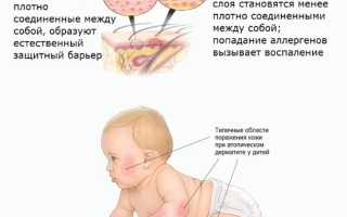 Атопический дерматит у детей