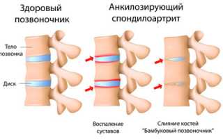 Болезнь Бехтерева и первые рентгенологические признаки