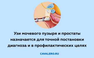 Как делают и как подготовиться к УЗИ простаты и мочевого пузыря у мужчин