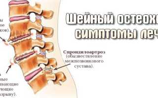 Шейный остеохондроз: симптомы и лечение