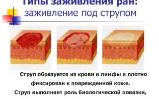Струп кожи