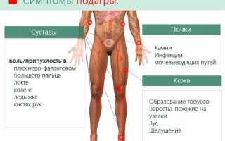Подагра: признаки и лечение заболевания