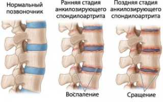 Какова будет история развития болезни при болезни Бехтерева?
