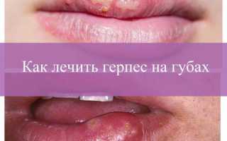 Герпес на губах лечение