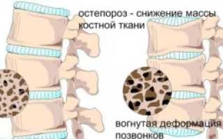 Эффективный массаж при остеопорозе