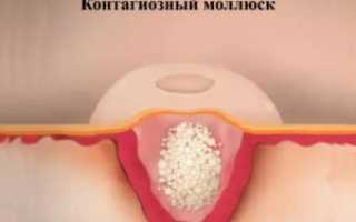 Контагиозный моллюск