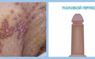 Половой герпес