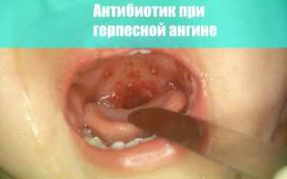 Антибиотик при герпесной ангине