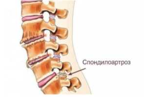 Cпондилоартроз поясничного отдела позвоночника: лечение