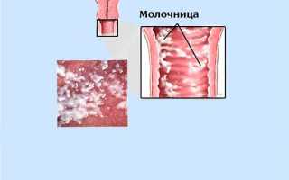 Вагинальный микоз после антибиотиков