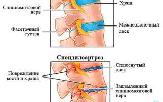 Факты о спондилоартрозе: виды, степени, инвалидность