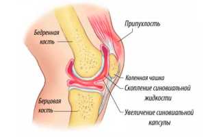 Опасно ли скопление жидкости в коленном суставе