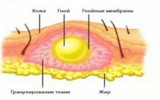 Множественные абсцессы кожи