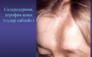 Макулярная атрофия кожи