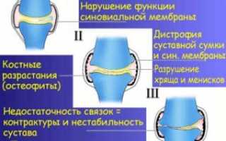 Как можно вылечить артроз коленного сустава 2 степени?