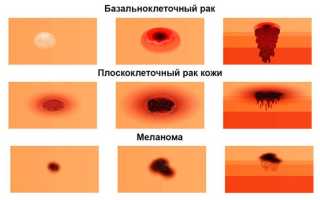 Плоскоклеточный рак кожи