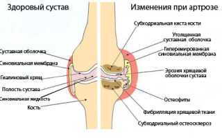 Применения УВЧ и других видов терапии при артрозе