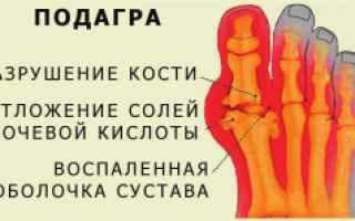 Как возникает и развивается подагра коленного сустава