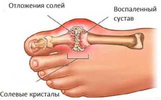 Заразна ли болезнь подагра?