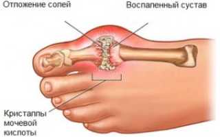 Профилактика осложнений при подагре