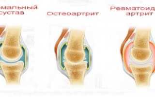 Как эффективно снять отек при ревматоидном артрите