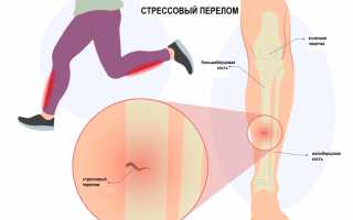 Перелом ноги: симптомы травмы и лечение