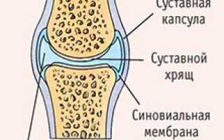 Диагностика и лечение бурсита и синовита
