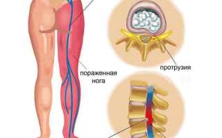 Защемление седалищного нерва: суть диагноза и лечение