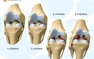 Как взаимодействуют коксартроз и алкоголь
